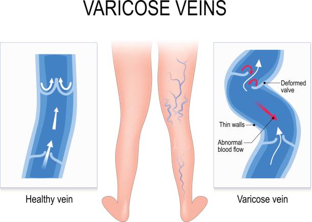 Varicose veins and Normal vein. Medical illustration